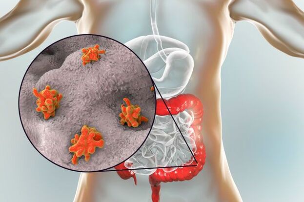 tipi di parassiti nel corpo umano