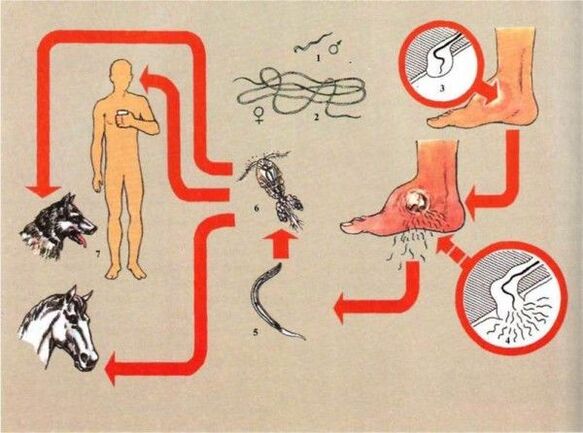 Sviluppo della dracunculiasi